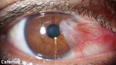 بیماری ناخنک چشم, علل ایجاد ناخنک چشم